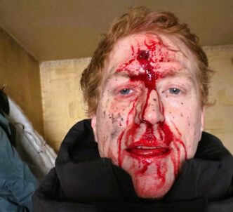 Волонтер Голландець вижив після удару ворожого дрона під час евакуації на Харківщині