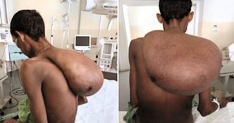 Фермер з 25‑кг пухлиною на шиї: операція і повне відновлення 1