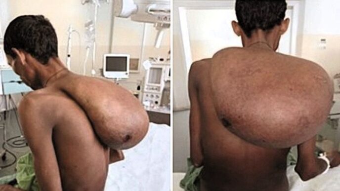 Фермер з 25‑кг пухлиною на шиї: операція і повне відновлення 3