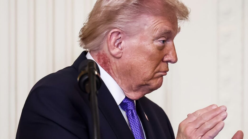 Вага та таємниця синців Трампа. Медики оприлюднили результати обстеження 3
