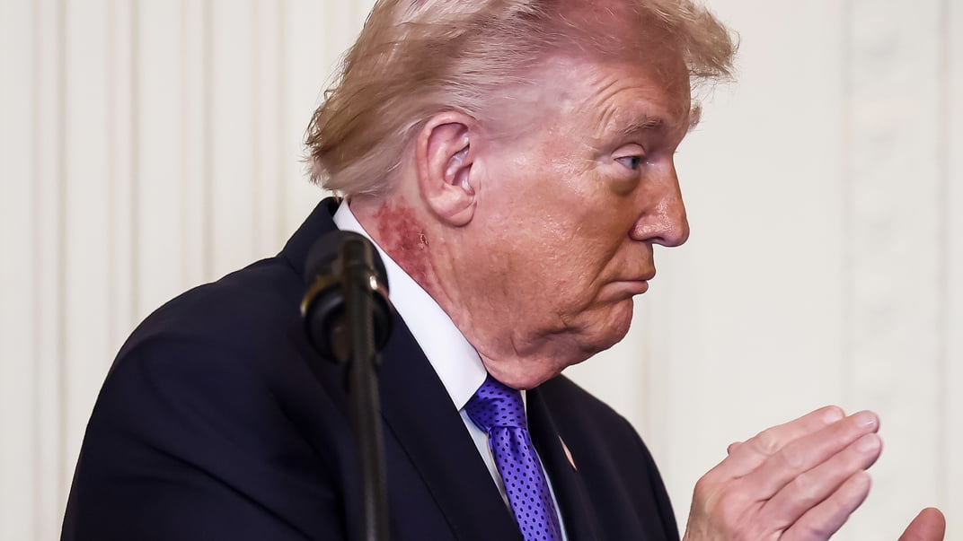 Вага та таємниця синців Трампа. Медики оприлюднили результати обстеження 121