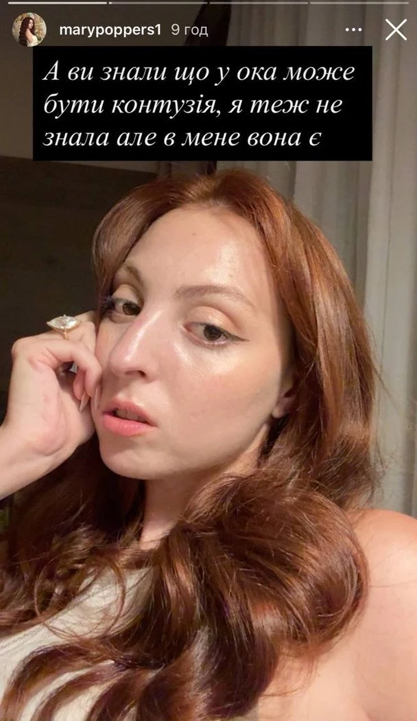 Дочка Олі Полякової Маша показала фото після ДТП: перелом носа та травма очниці 8 Дочка Олі Полякової Маша показала фото після ДТП: перелом носа та травма очниці 7