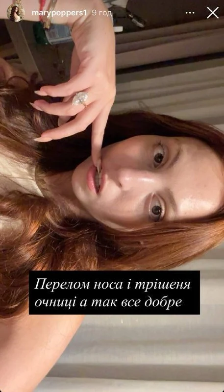 Дочка Олі Полякової Маша показала фото після ДТП: перелом носа та травма очниці 12 Дочка Олі Полякової Маша показала фото після ДТП: перелом носа та травма очниці 11